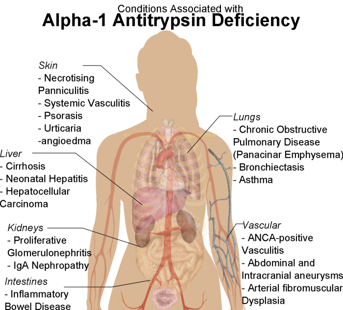 Alpha-1-Antitrypsin Deficiency (A1AD)