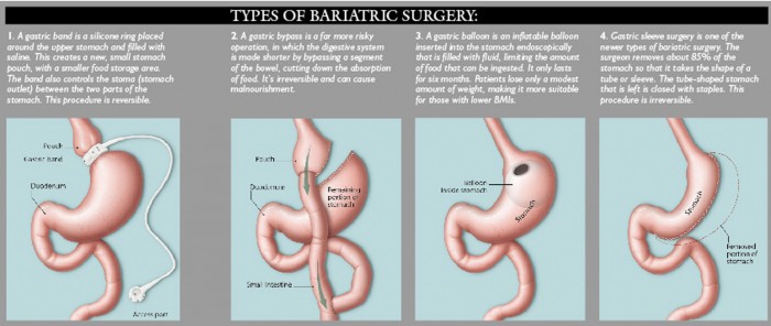 Bariatric surgeries Gastric yypass
