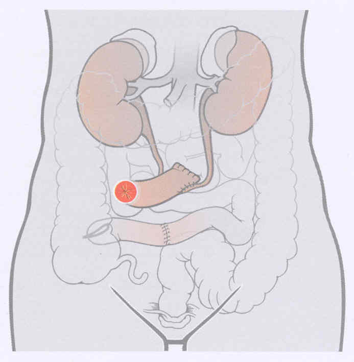 Bladder Cystectomy
