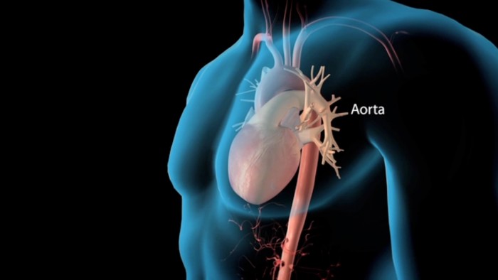Thoracic Aortic Dissection Repair