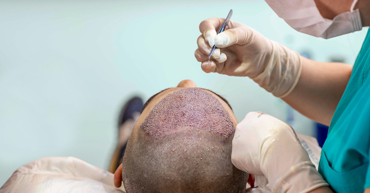 Will you need another hair transplantation?