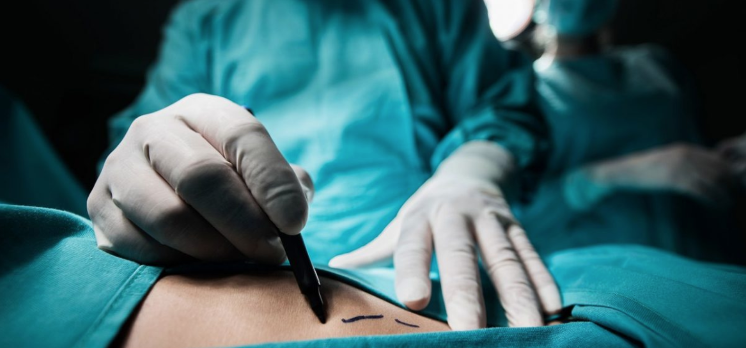 Liposuction