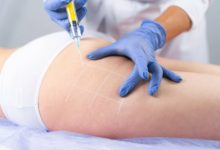 cellulite mesotherapy