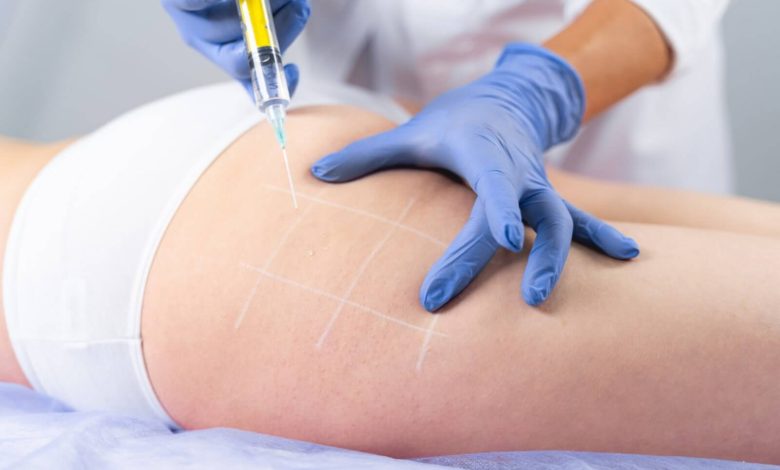 cellulite mesotherapy