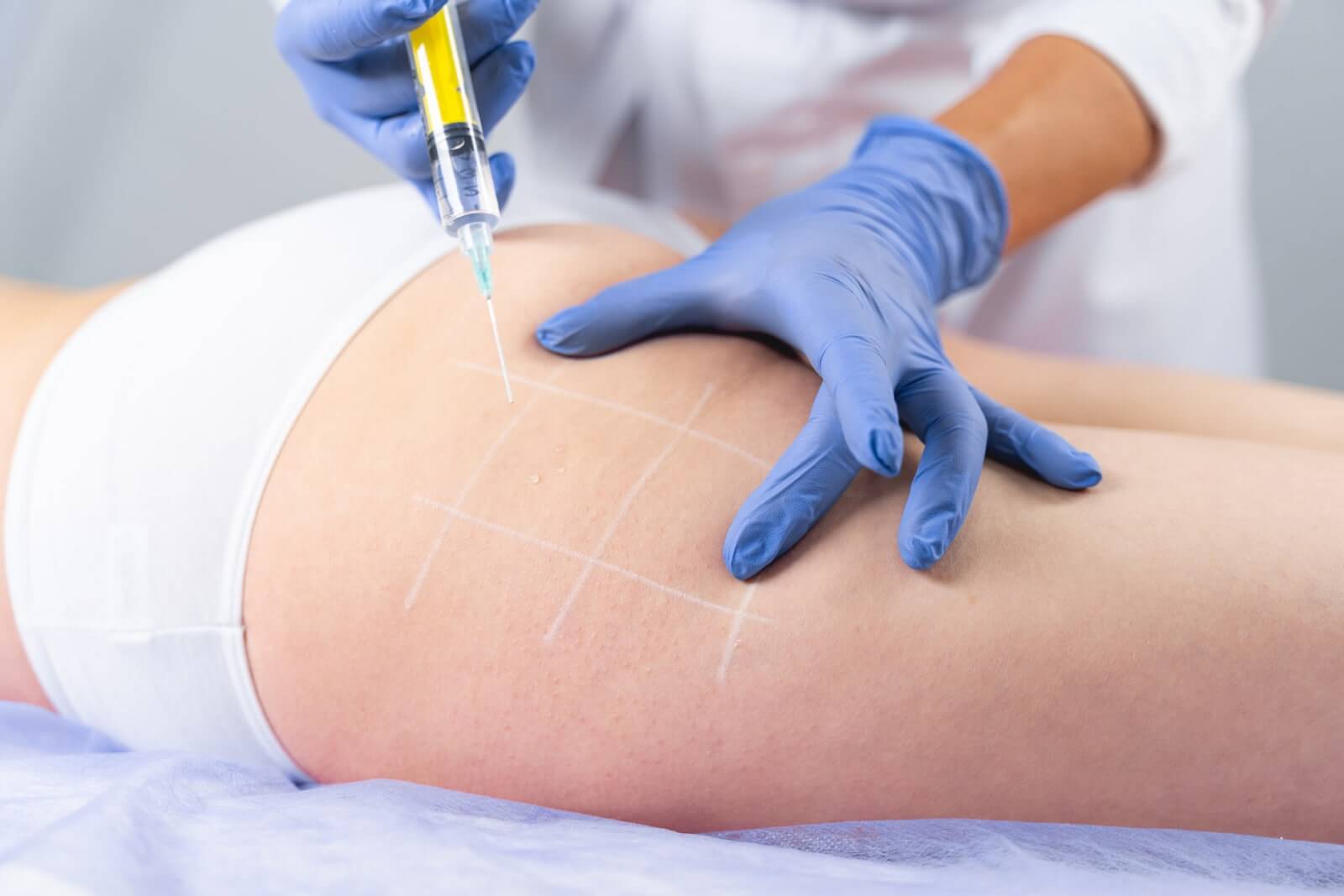 cellulite mesotherapy