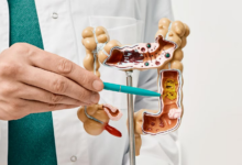 Colon Cancer