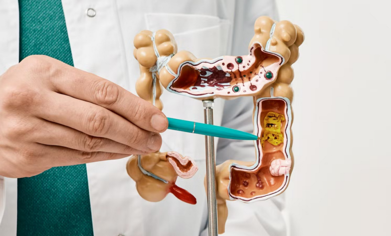 Colon Cancer