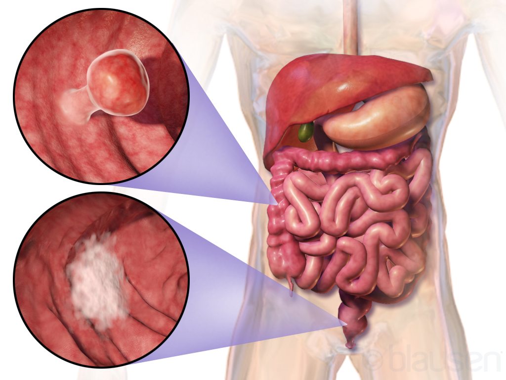 Forms of colon cancer